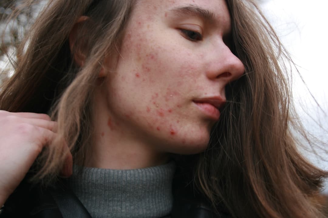 Stress, Skin, and Silence, A Missionary’s Acne Story