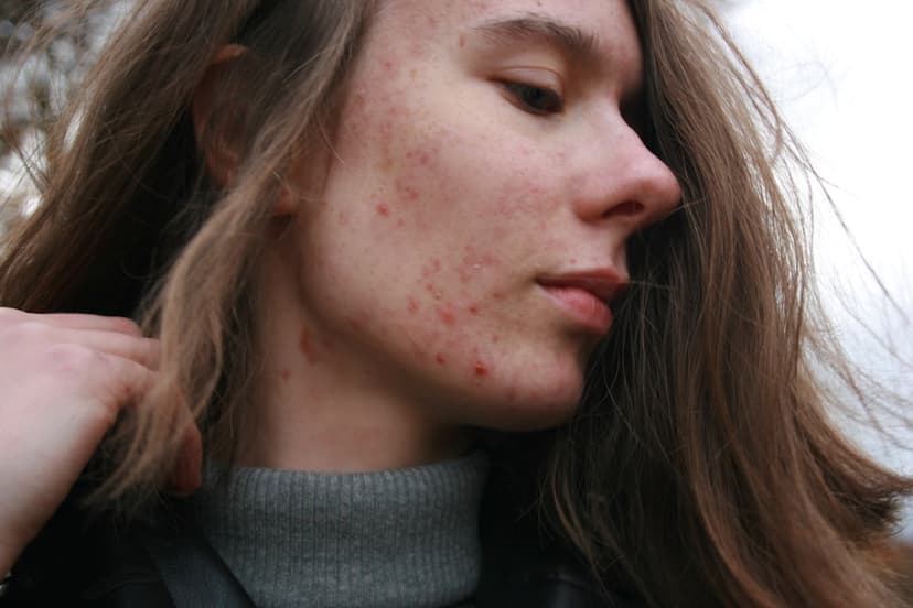 Stress, Skin, and Silence, A Missionary’s Acne Story